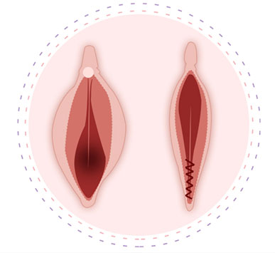 Vaginal Bleaching
